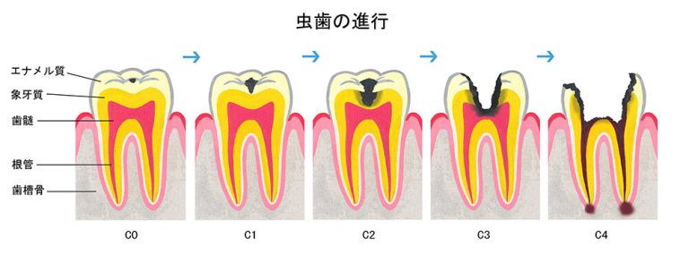 虫歯の治し方