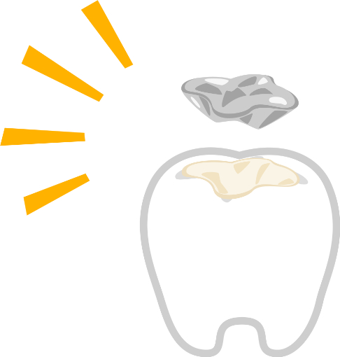 歯の詰め物が取れた時の対処法
