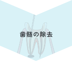 歯髄の除去