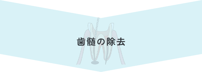 歯髄の除去