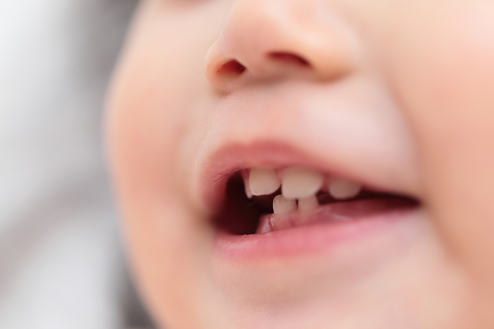 進行が速い子供の虫歯について