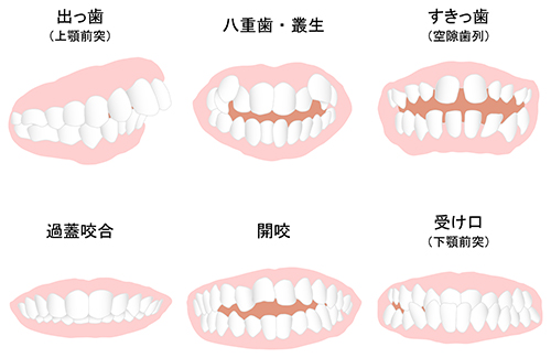 子供によくある不正咬合の問題