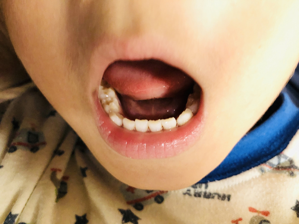 子供の歯に虫歯ができてしまう前に