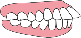 出っ歯は自力で治せない
