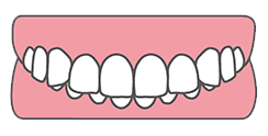 噛み合わせが深い「過蓋咬合(かがいこうごう)」とは？