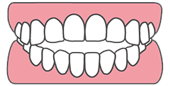 前歯で噛めない「開咬」とは