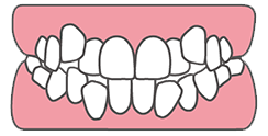 歯がガタガタな状態「叢生(そうせい)」とは？