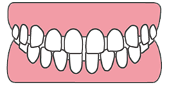 すきっ歯・空隙歯列(くうげきしれつ)とはどんな状態？